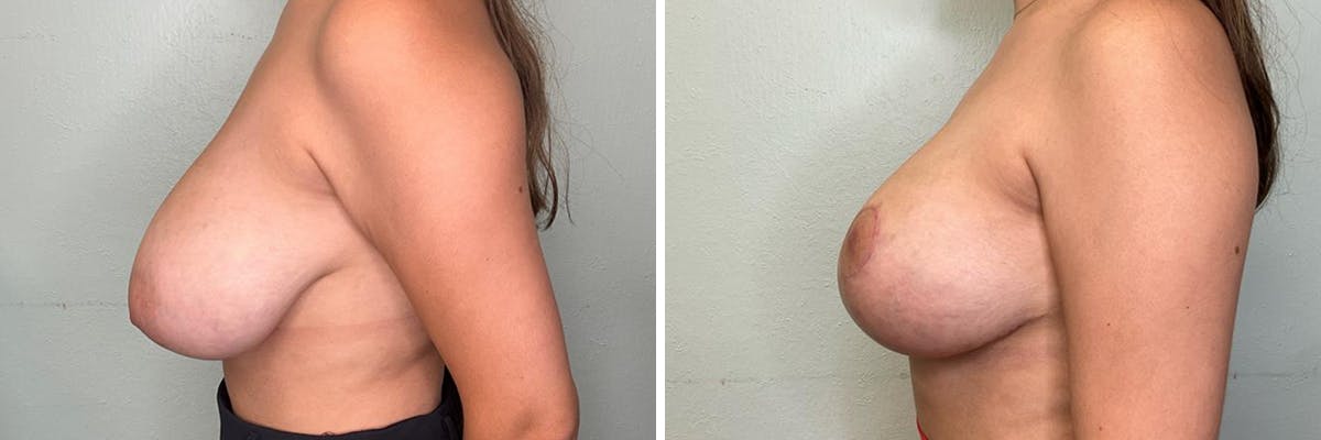 Breast Reduction Before & After Gallery - Patient 400425 - Image 3