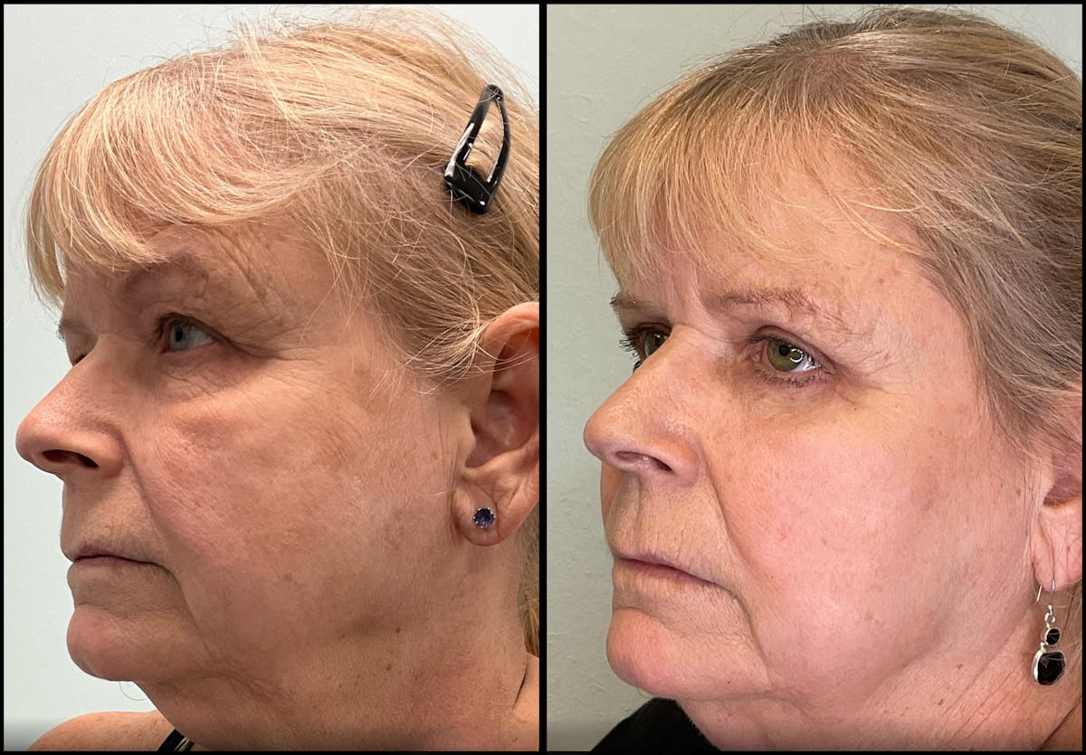 Eyelid Surgery Before & After Gallery - Patient 331654 - Image 3