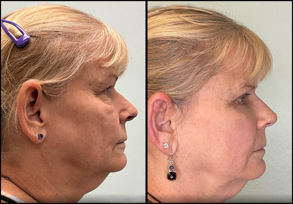 Eyelid Surgery Before & After Gallery - Patient 331654 - Image 4