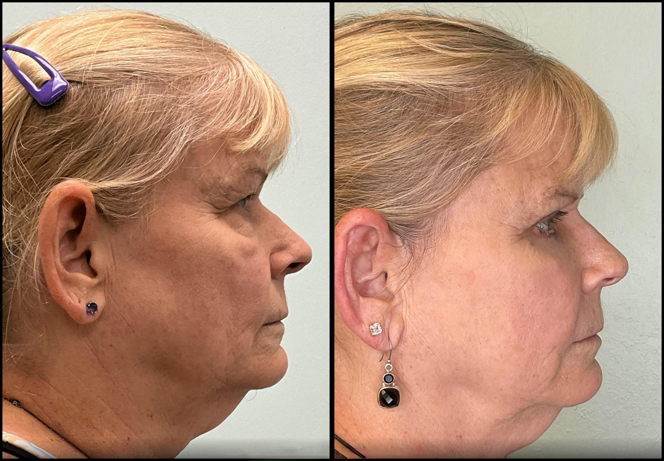Eyelid Surgery Before & After Gallery - Patient 331654 - Image 4