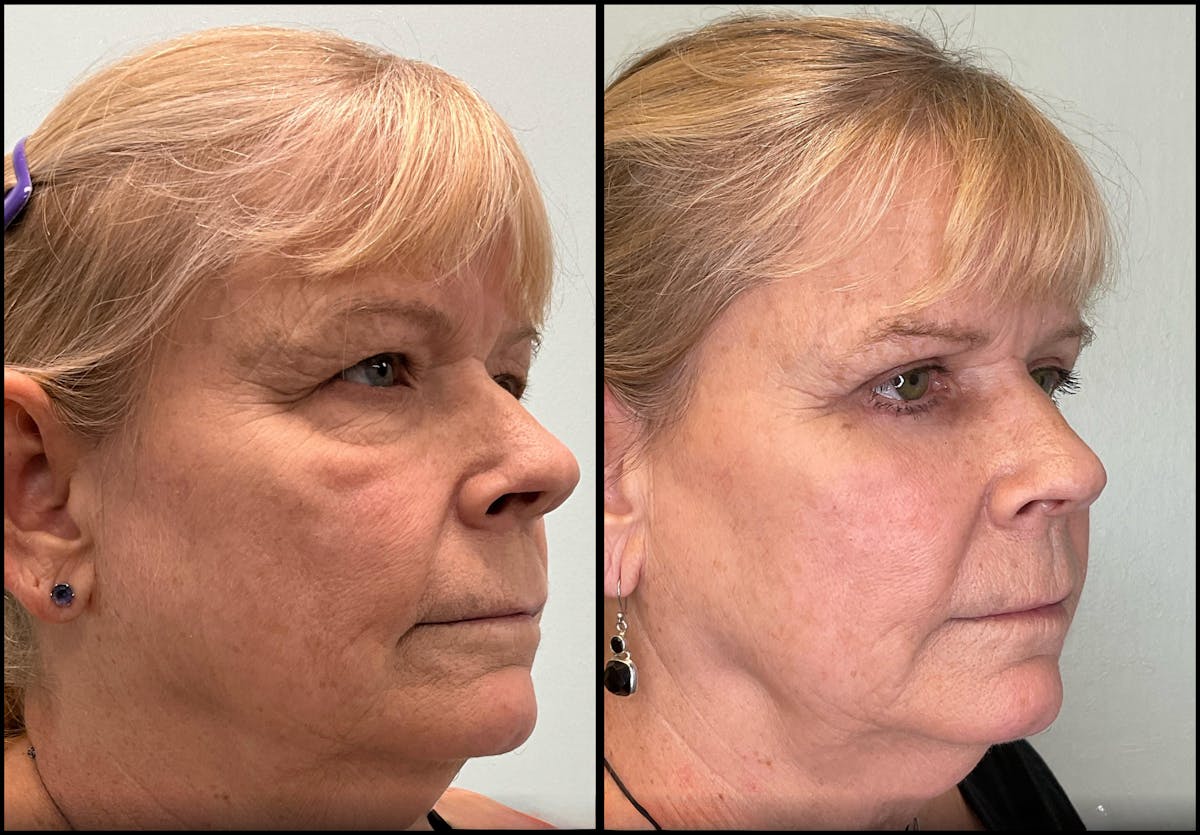 Eyelid Surgery Before & After Gallery - Patient 331654 - Image 5