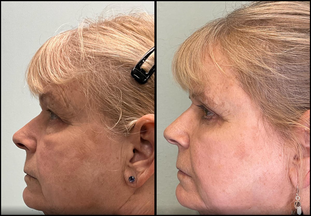 Eyelid Surgery Before & After Gallery - Patient 331654 - Image 2