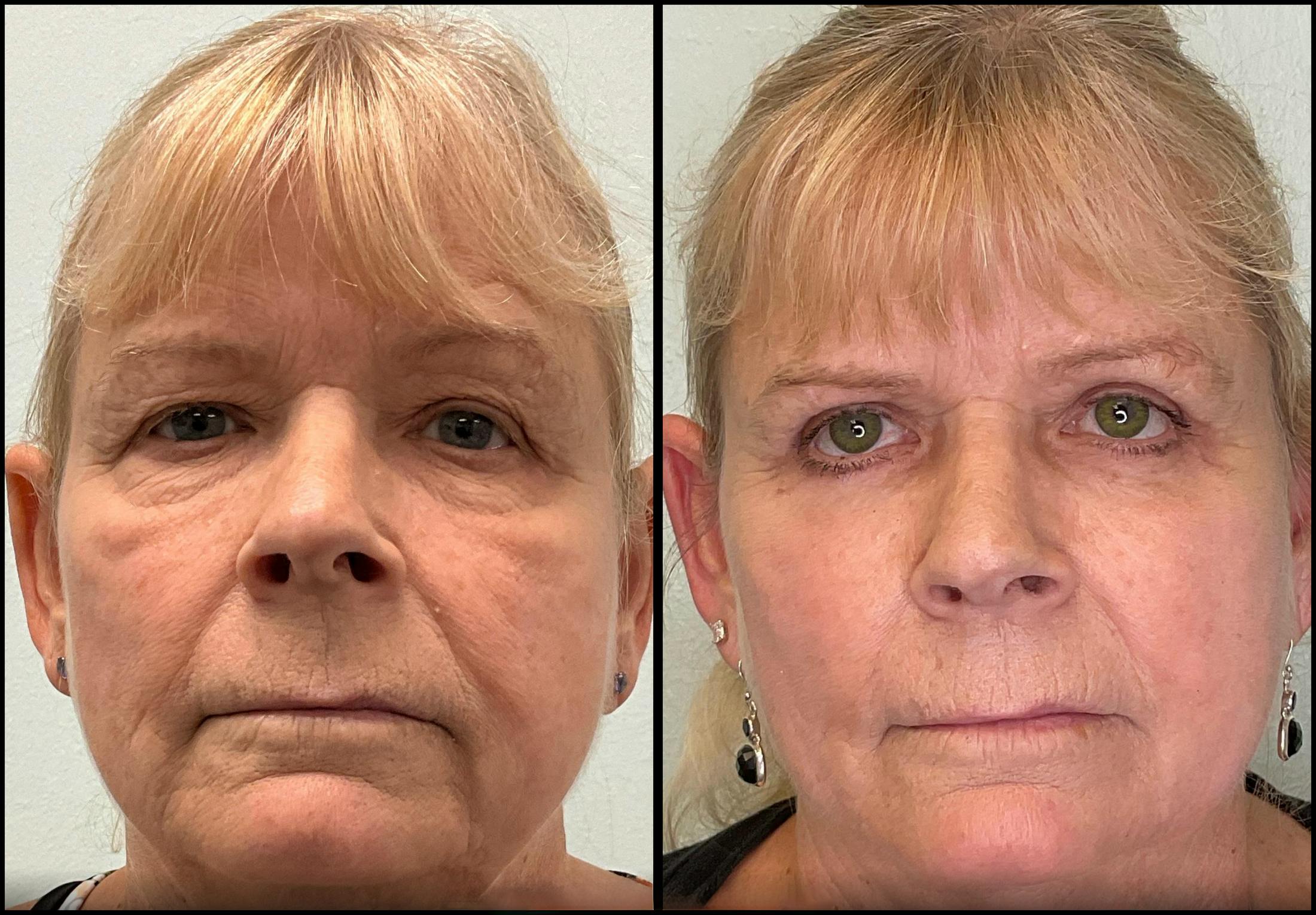 Eyelid Surgery Before & After Gallery - Patient 331654 - Image 1