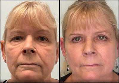 Eyelid Surgery Before & After Gallery - Patient 331654 - Image 1