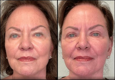 Eyelid Surgery Before & After Gallery - Patient 142440 - Image 1
