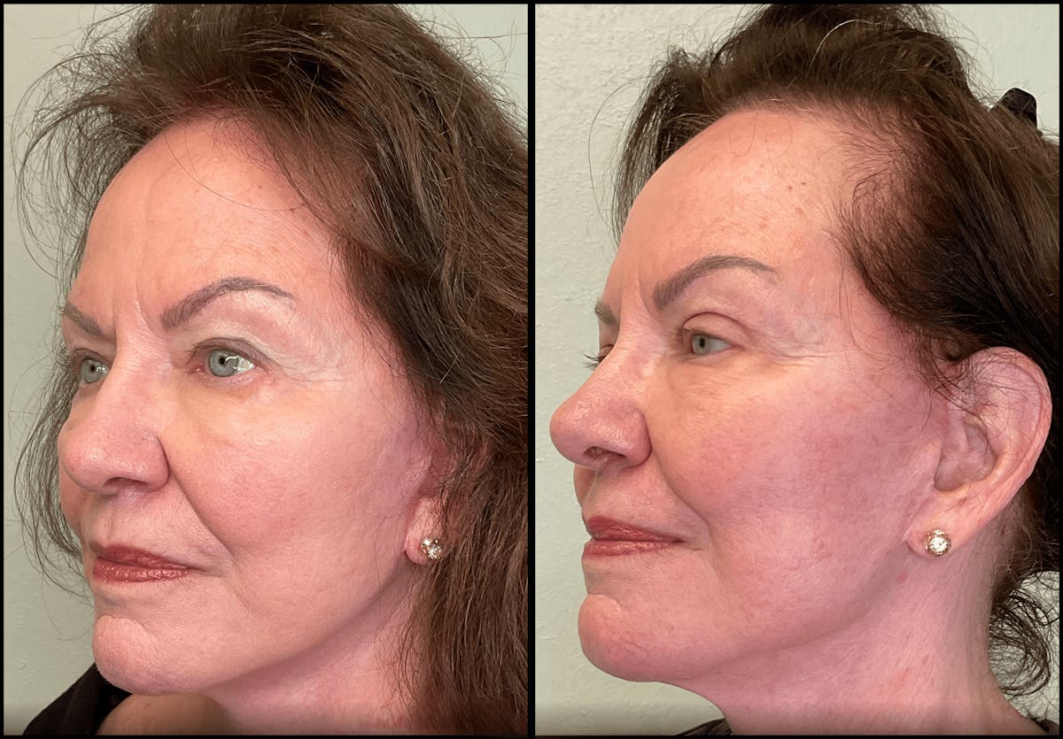 Eyelid Surgery Before & After Gallery - Patient 142440 - Image 2