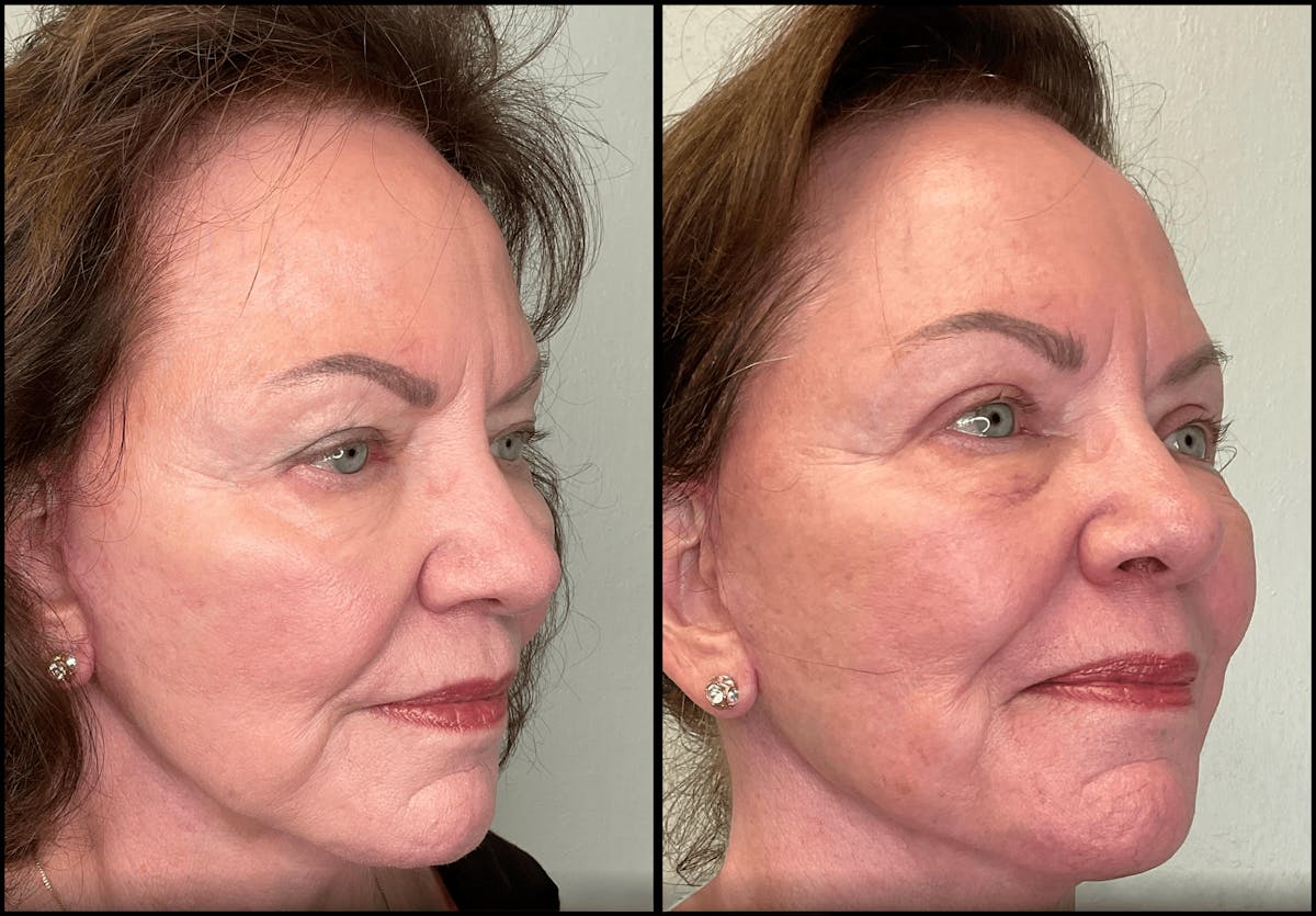 Eyelid Surgery Before & After Gallery - Patient 142440 - Image 3