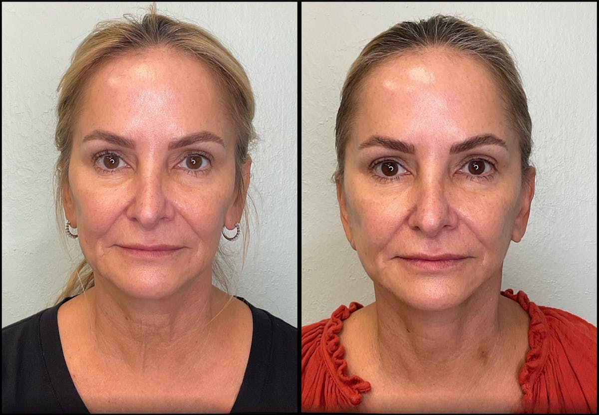 Modified Facelift Before & After Gallery - Patient 256274 - Image 1