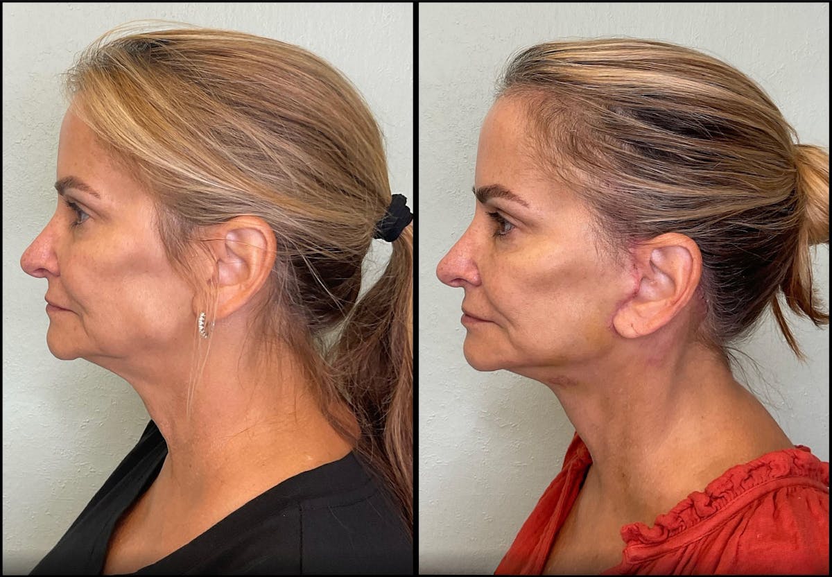 Modified Facelift Before & After Gallery - Patient 256274 - Image 2