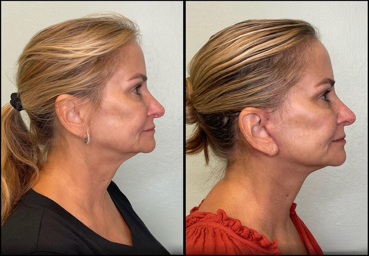 Modified Facelift Before & After Gallery - Patient 256274 - Image 3