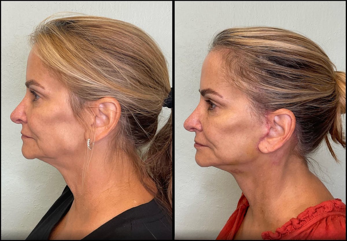 Modified Facelift Before & After Gallery - Patient 256274 - Image 4