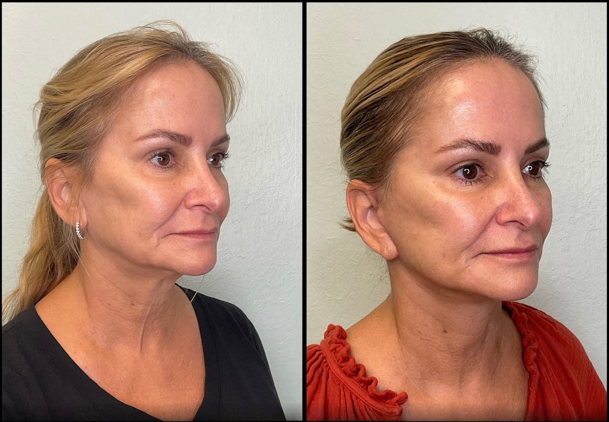 Modified Facelift Before & After Gallery - Patient 256274 - Image 5