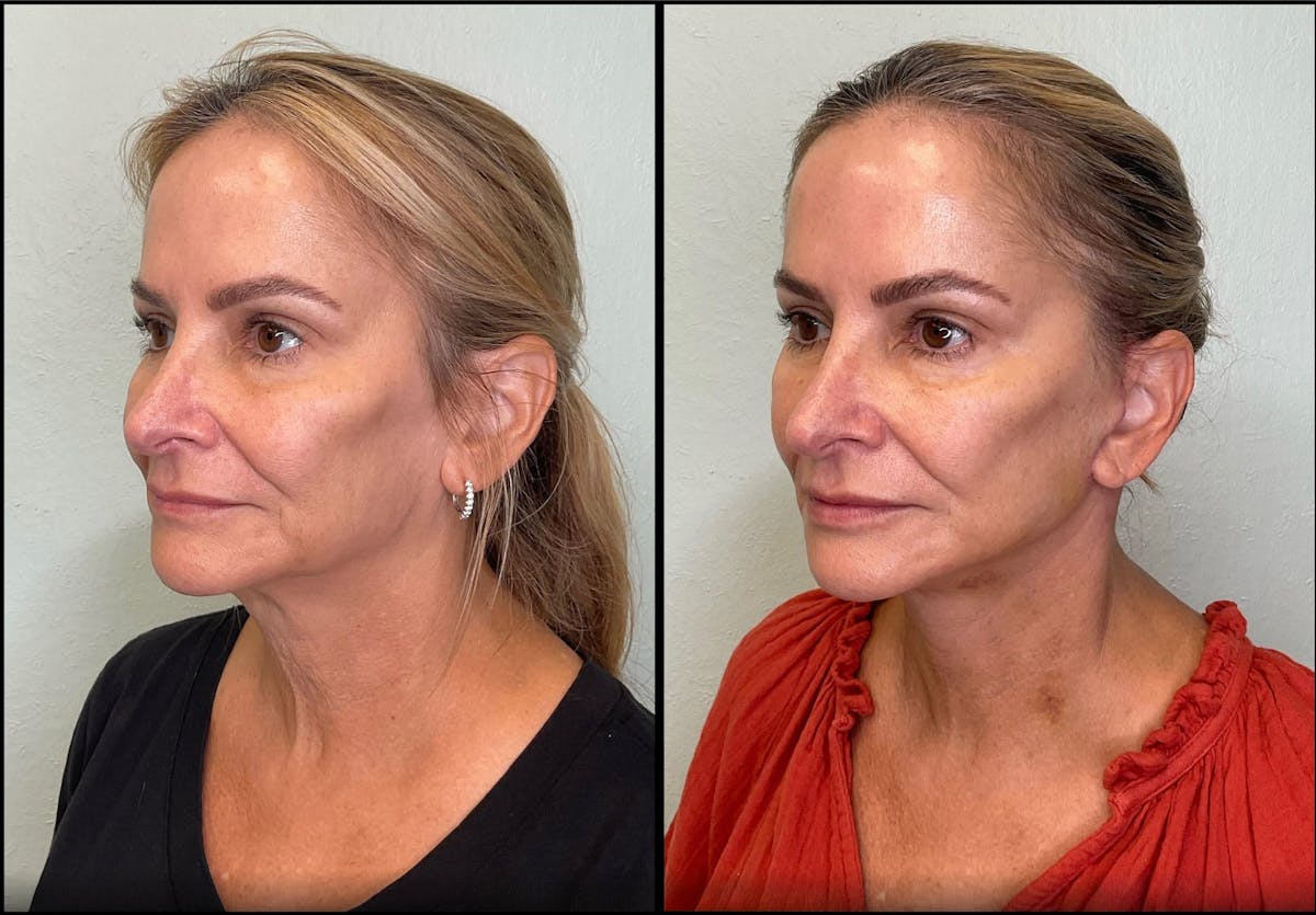 Modified Facelift Before & After Gallery - Patient 256274 - Image 6