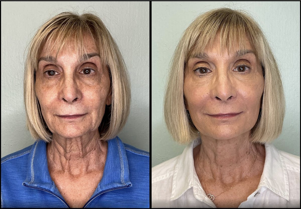 Modified Facelift Before & After Gallery - Patient 179277 - Image 1