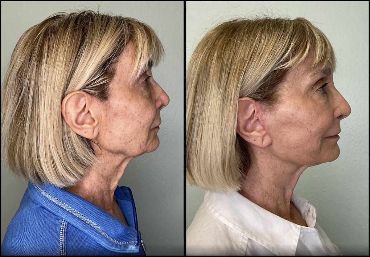 Modified Facelift Before & After Gallery - Patient 179277 - Image 3