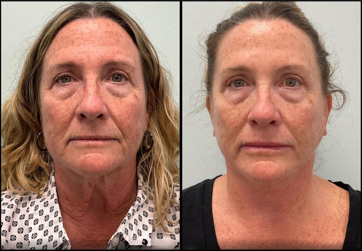 Modified Facelift Before & After Gallery - Patient 290371 - Image 1