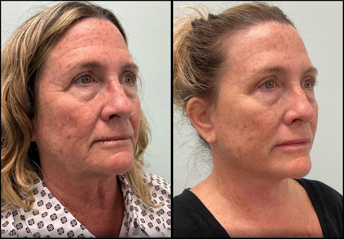 Modified Facelift Before & After Gallery - Patient 290371 - Image 2