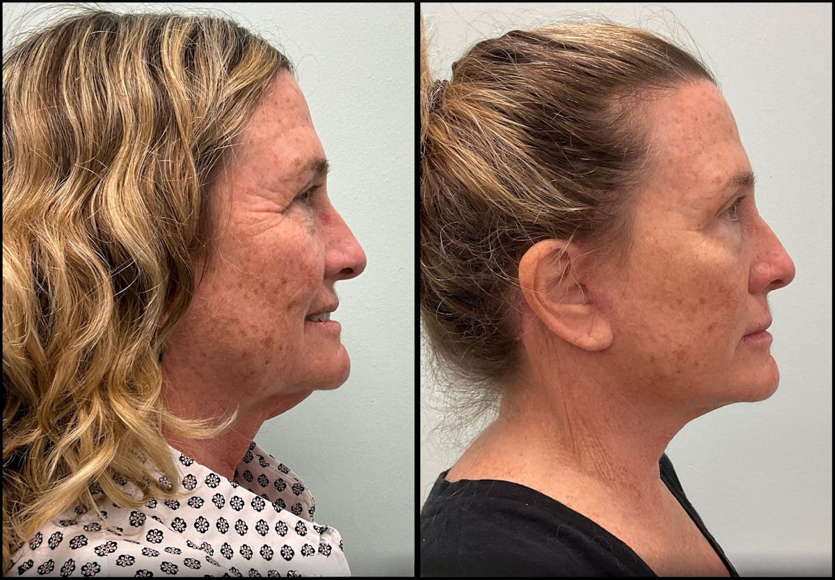 Modified Facelift Before & After Gallery - Patient 290371 - Image 3