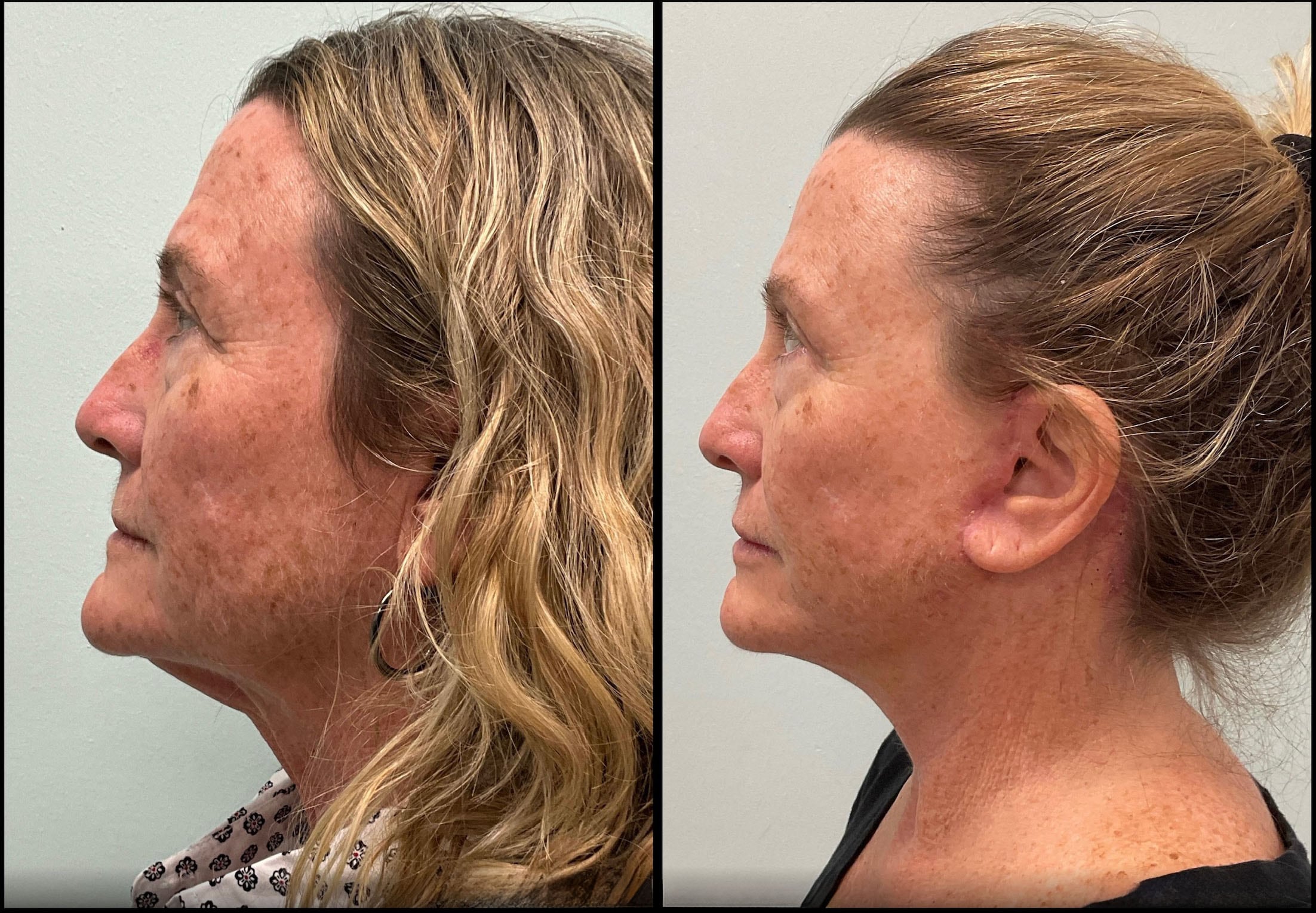 Patient 276605 | Modified Neck Lift Before & After Photos | Dr