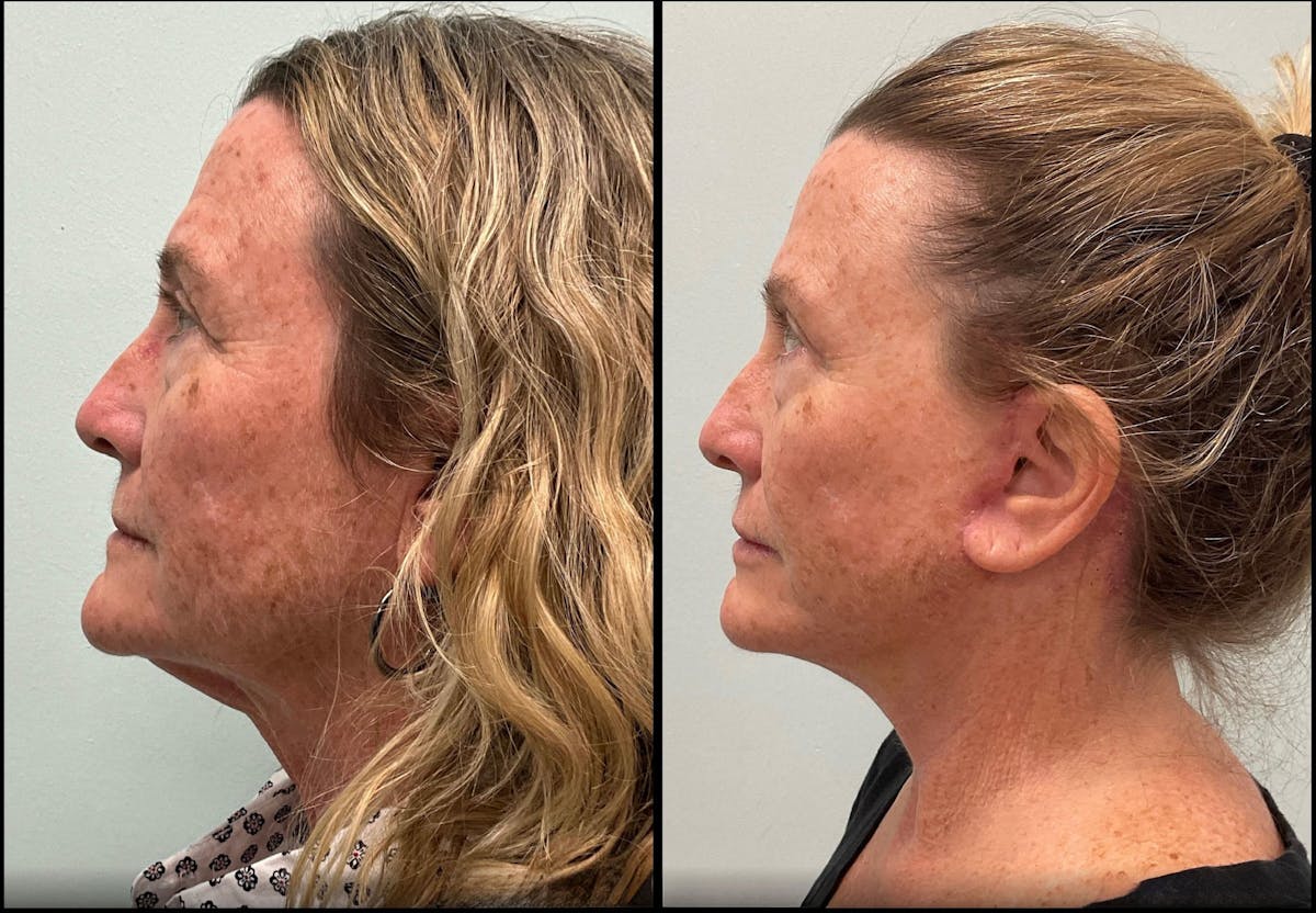Modified Facelift Before & After Gallery - Patient 290371 - Image 4