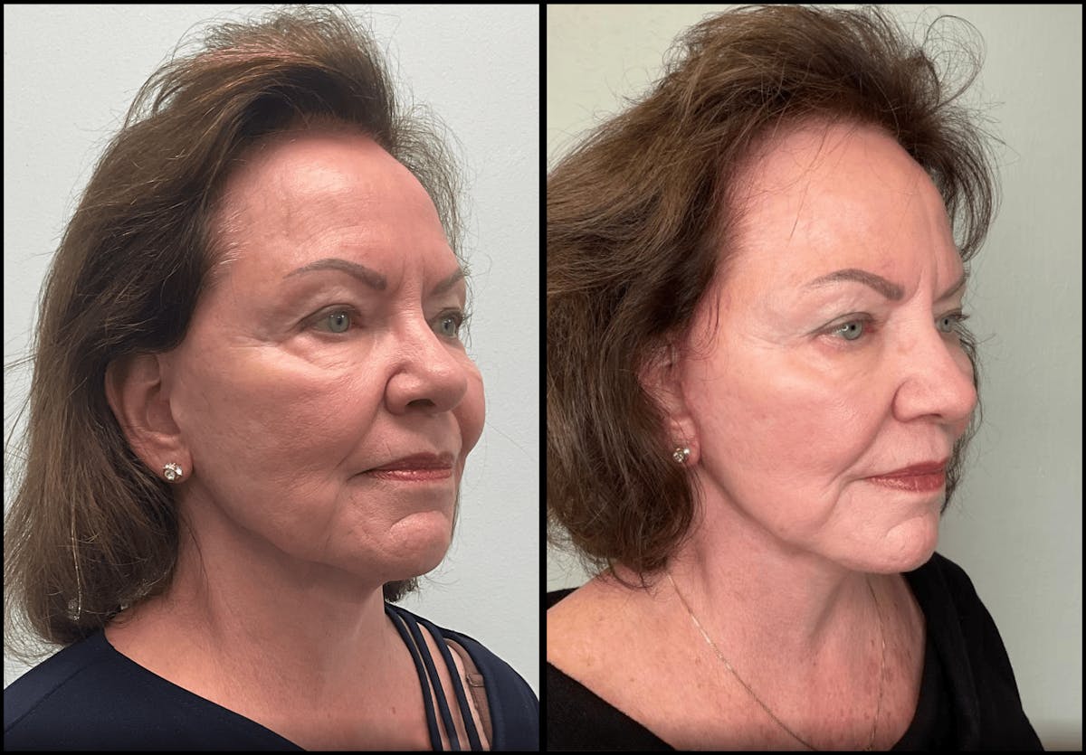 Modified Neck Lift Before & After Gallery - Patient 100597 - Image 4