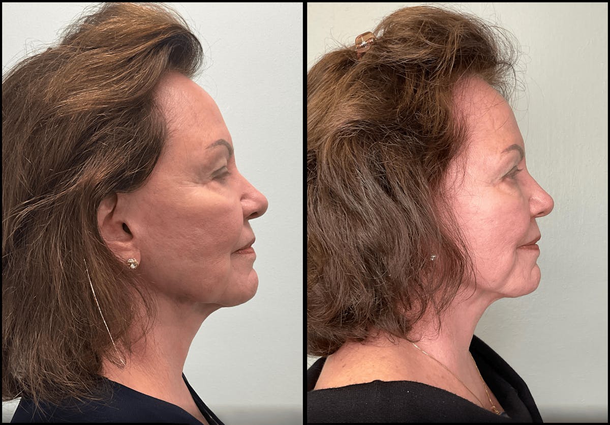 Modified Neck Lift Before & After Gallery - Patient 100597 - Image 3