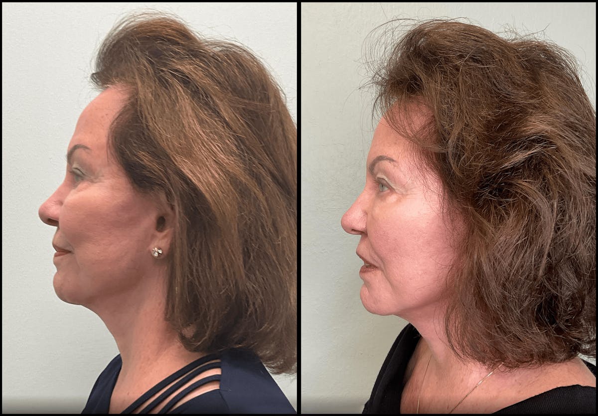 Modified Neck Lift Before & After Gallery - Patient 100597 - Image 2