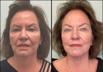Modified Facelift Before & After Gallery - Patient 114810 - Image 1