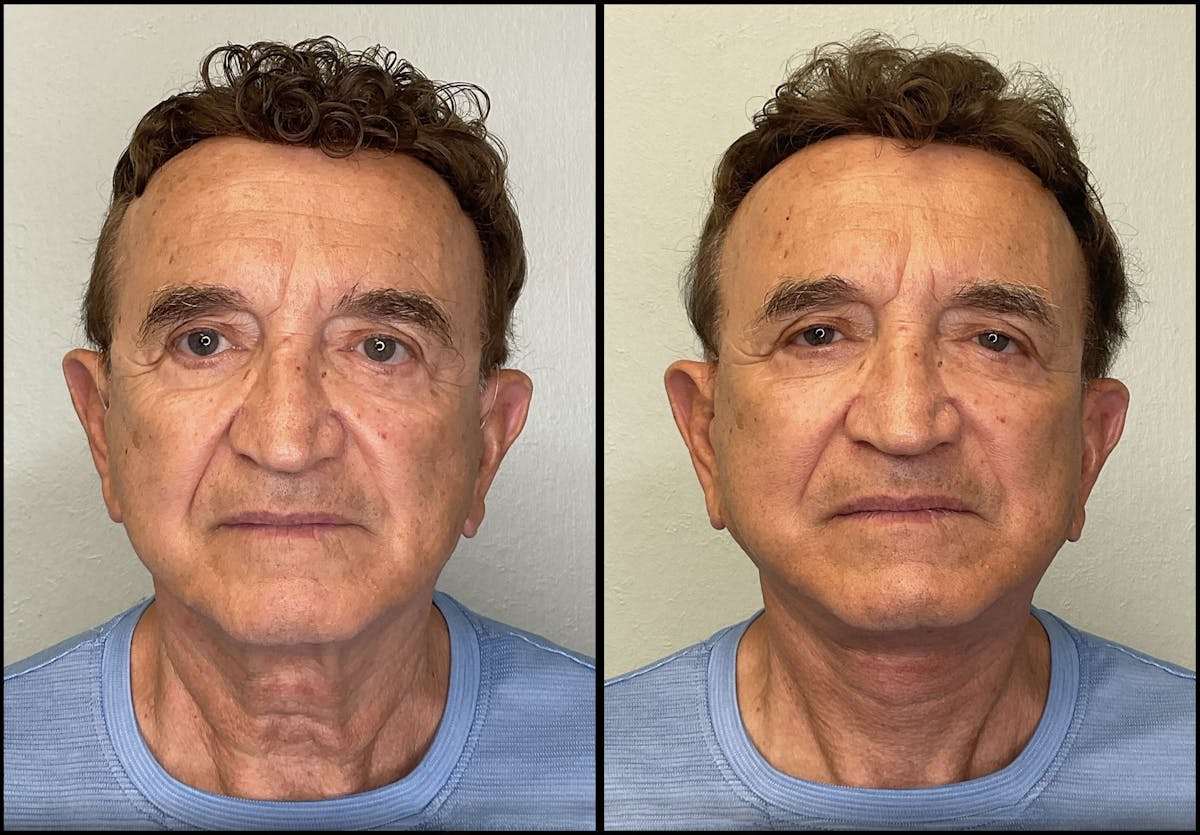 Modified Facelift Before & After Gallery - Patient 394362 - Image 1