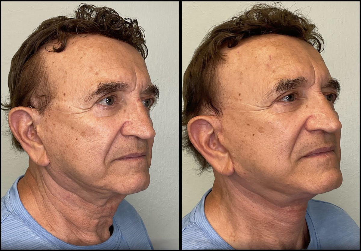 Modified Facelift Before & After Gallery - Patient 394362 - Image 2