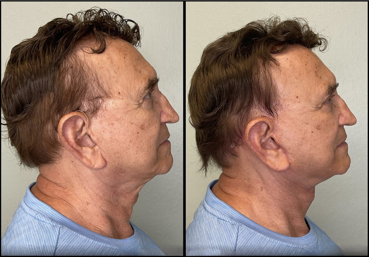 Modified Facelift Before & After Gallery - Patient 394362 - Image 3