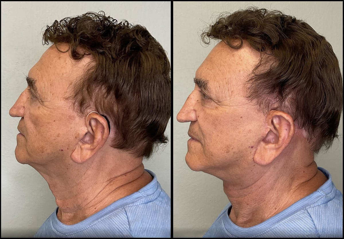 Modified Facelift Before & After Gallery - Patient 394362 - Image 5