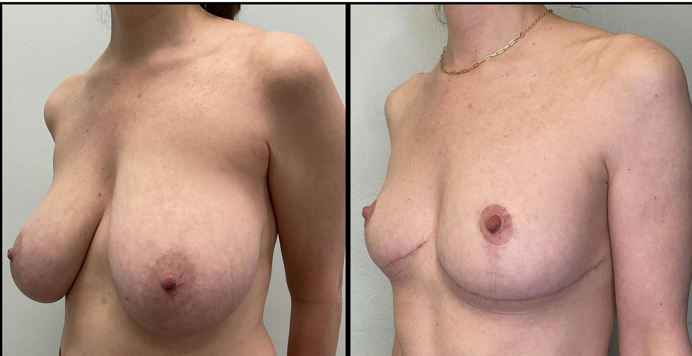 Breast Reduction Before & After Gallery - Patient 271752 - Image 2