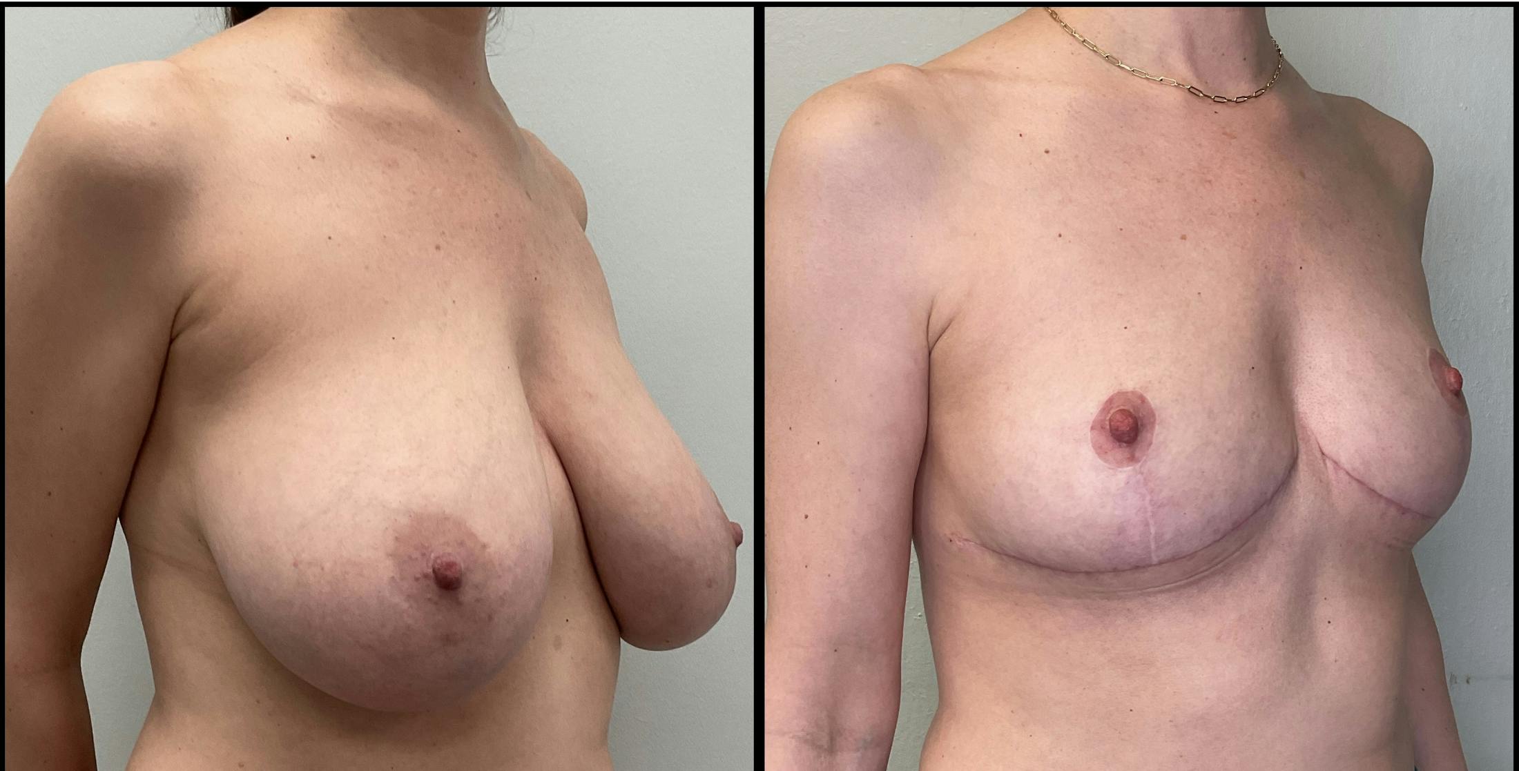 Breast Reduction Before & After Gallery - Patient 271752 - Image 3