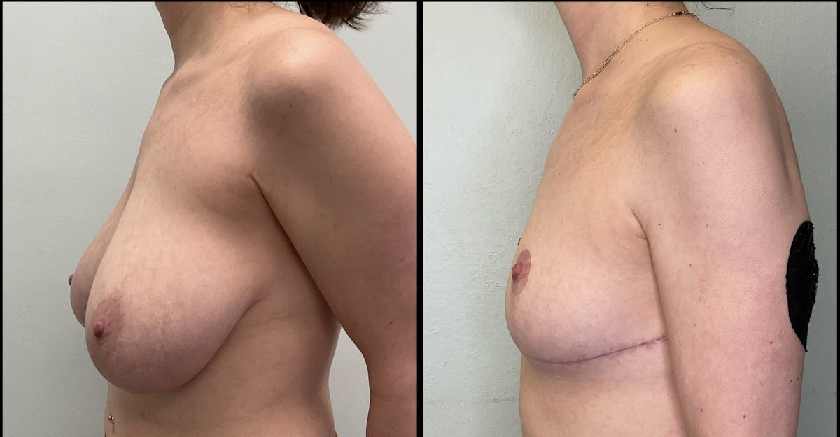 Breast Reduction Before & After Gallery - Patient 271752 - Image 4