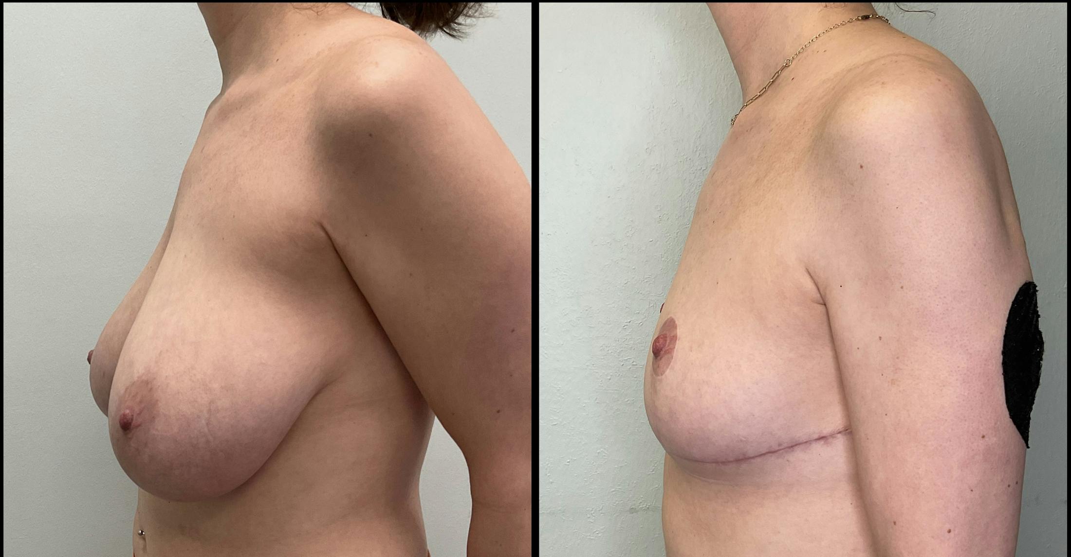 Breast Reduction Before & After Gallery - Patient 271752 - Image 4