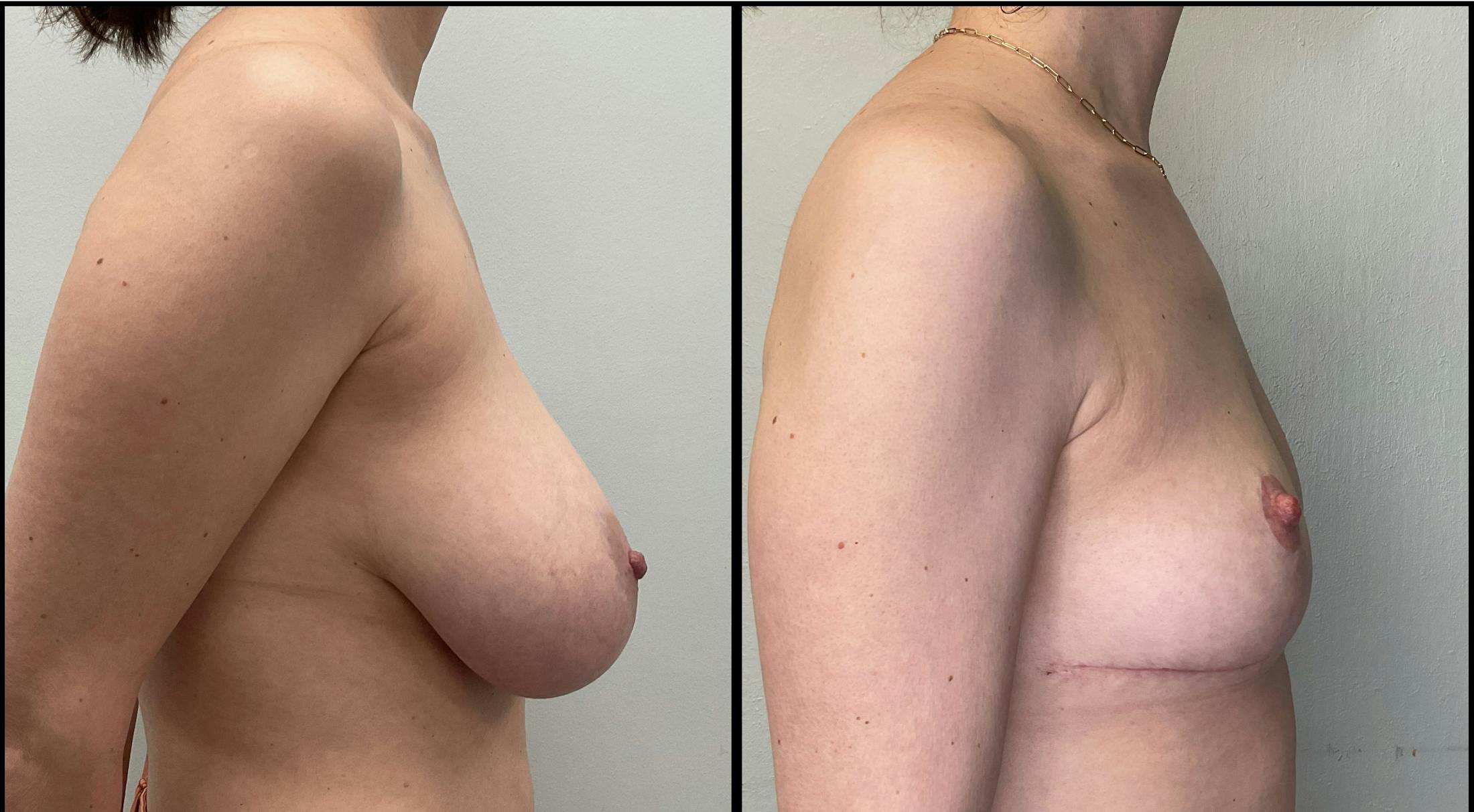 Breast Reduction Before & After Gallery - Patient 271752 - Image 5