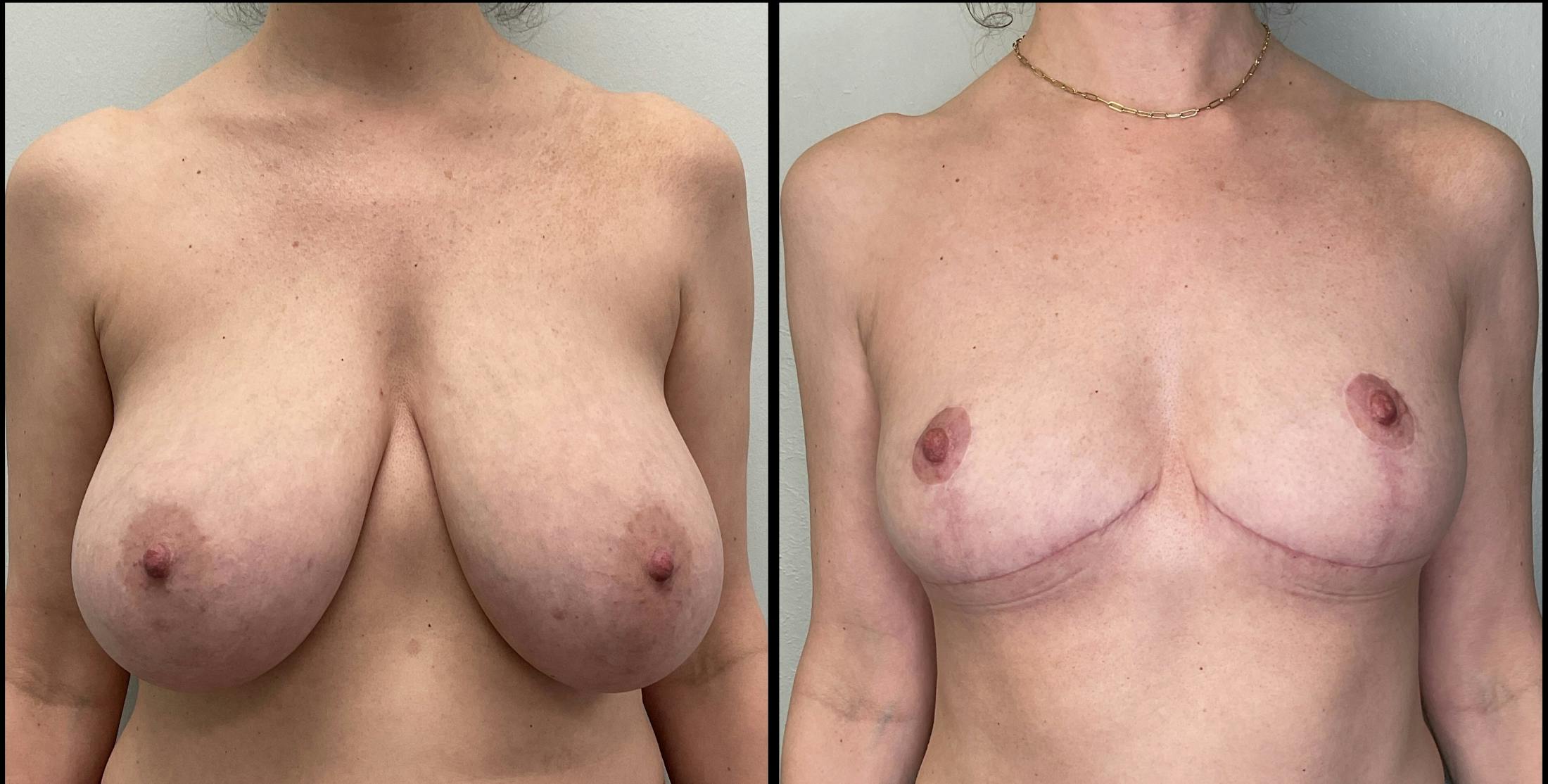 Breast Reduction Before & After Gallery - Patient 271752 - Image 1