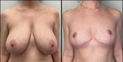 Breast Reduction Before & After Gallery - Patient 271752 - Image 1