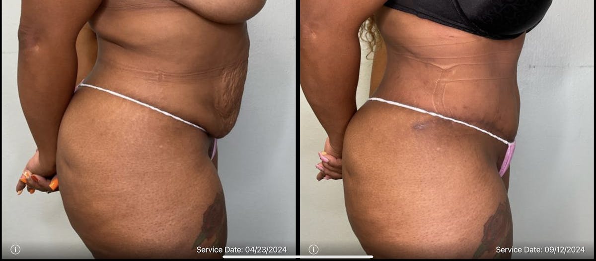 Tummy Tuck Before & After Gallery - Patient 334375 - Image 4