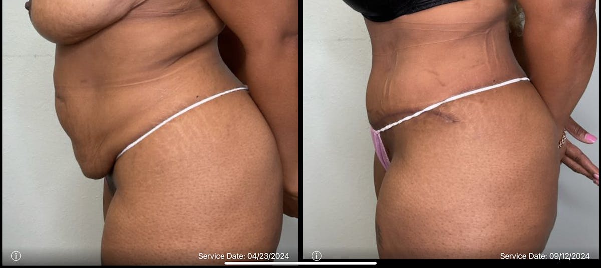 Tummy Tuck Before & After Gallery - Patient 334375 - Image 3