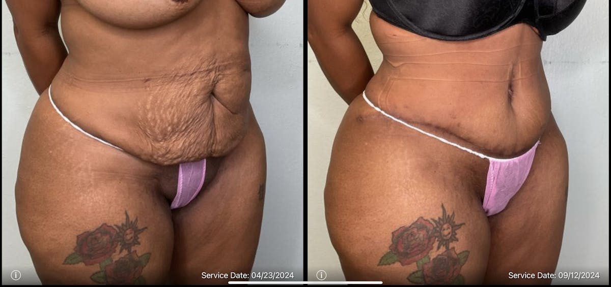 Tummy Tuck Before & After Gallery - Patient 334375 - Image 2