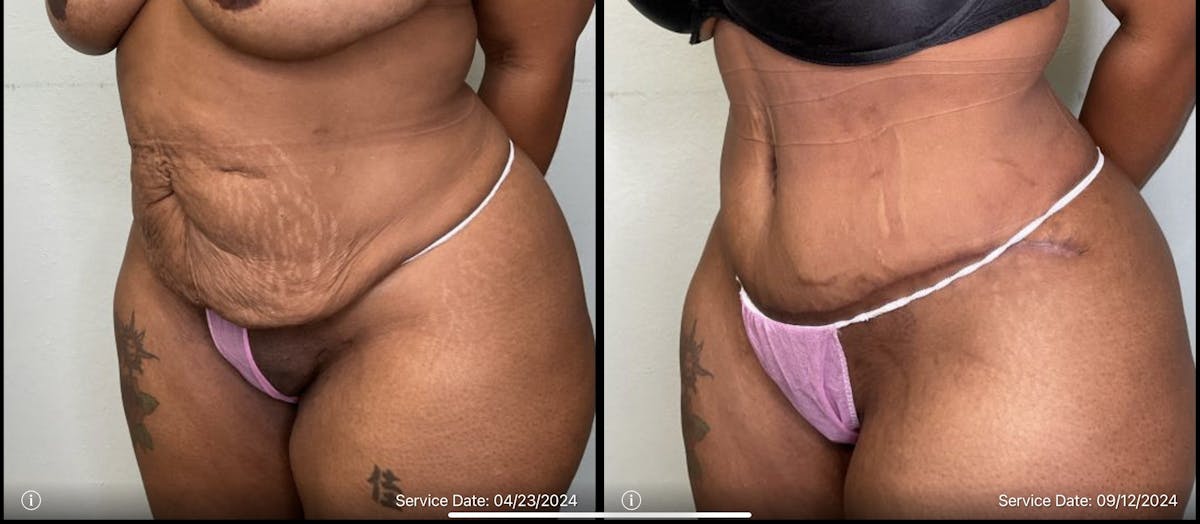 Tummy Tuck Before & After Gallery - Patient 334375 - Image 1