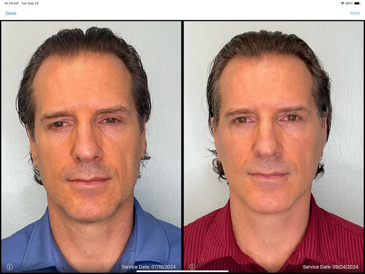 Modified Facelift Before & After Gallery - Patient 383827 - Image 1