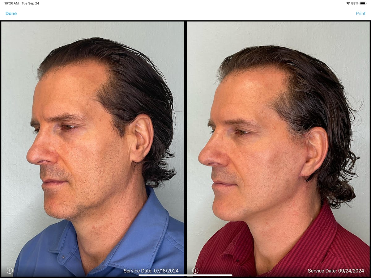 Modified Facelift Before & After Gallery - Patient 383827 - Image 3