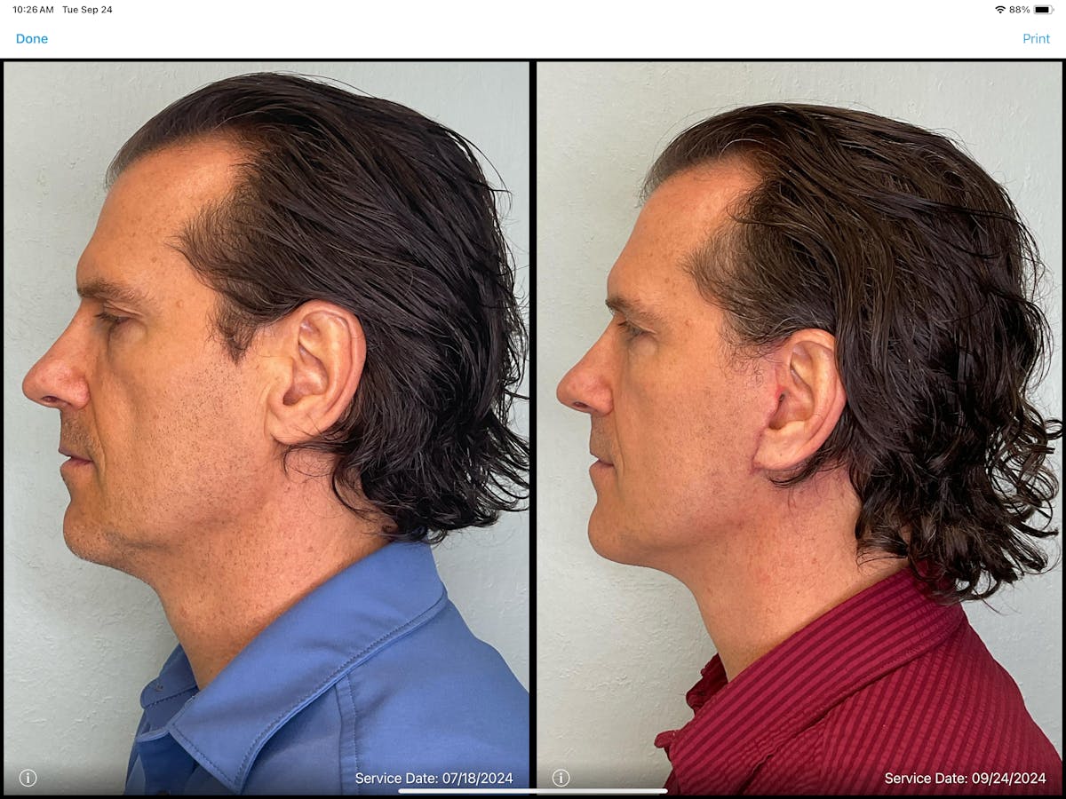 Modified Facelift Before & After Gallery - Patient 383827 - Image 4
