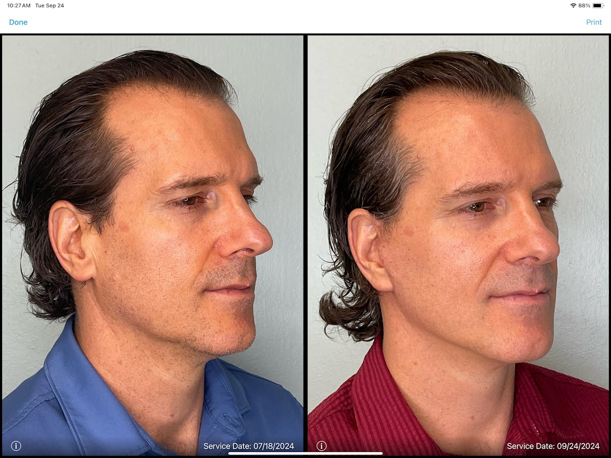 Modified Facelift Before & After Gallery - Patient 383827 - Image 5