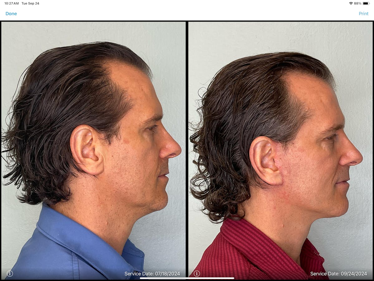 Modified Facelift Before & After Gallery - Patient 383827 - Image 2