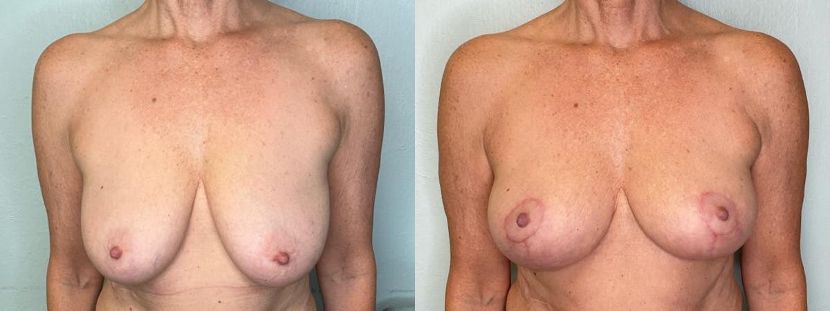 Breast Lift Before & After Gallery - Patient 361119 - Image 1
