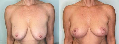 Breast Lift Before & After Gallery - Patient 361119 - Image 1